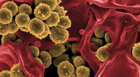 Sepsis PCR En Tiempo Real